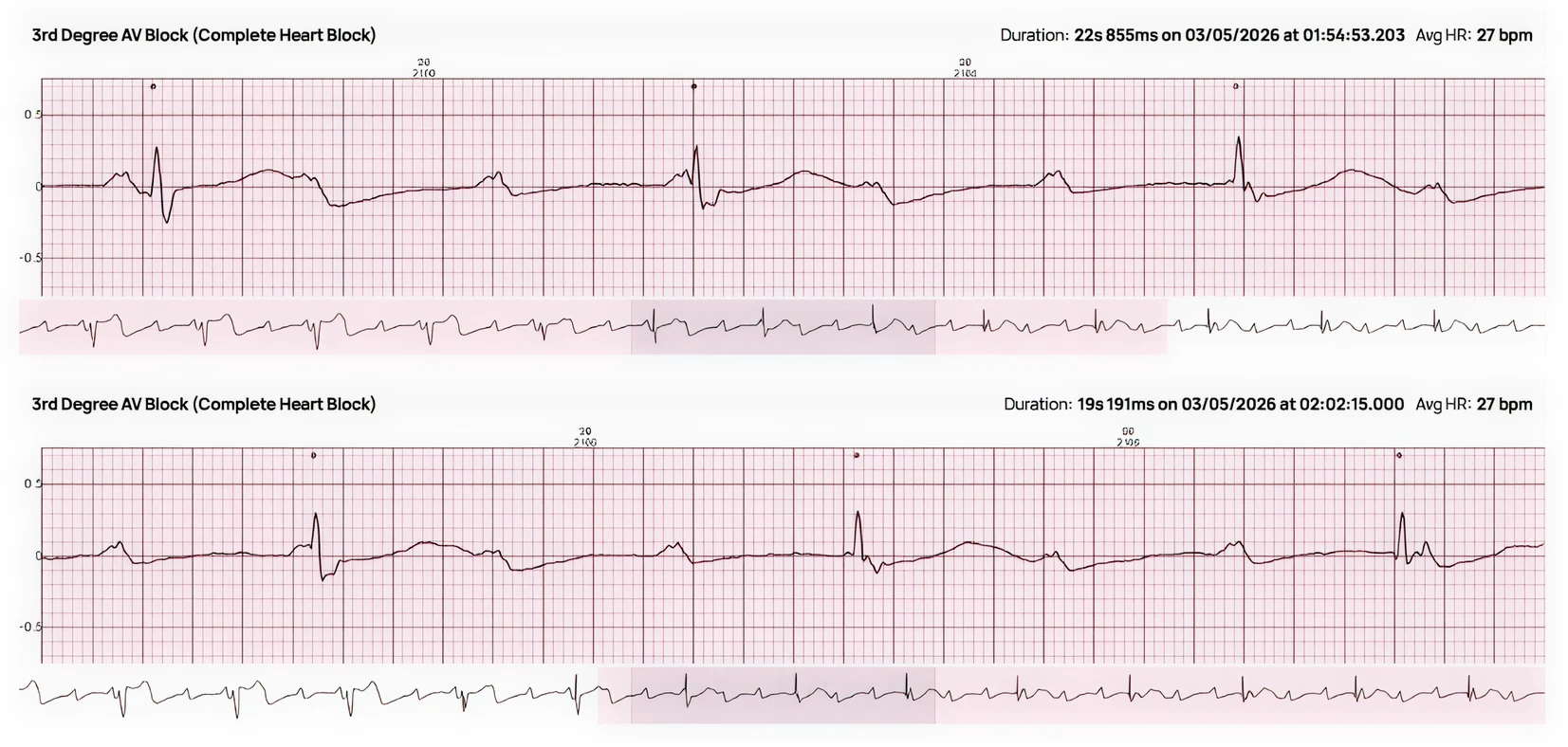 S-Patch cardiac monitor detecting heart condition