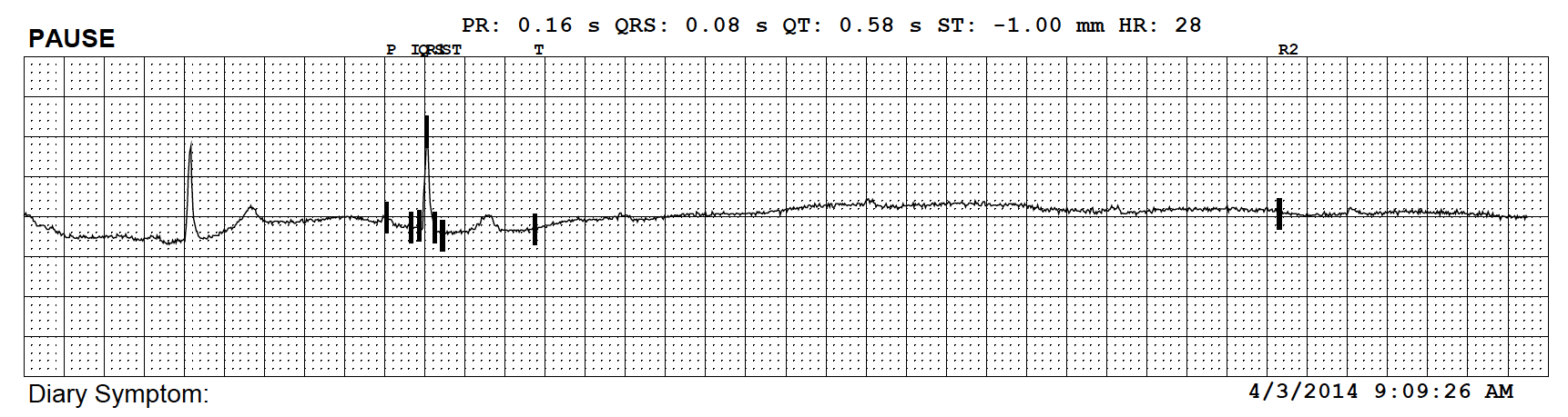 Lead-Wire cardiac monitor detecting life-saving arrhythmia